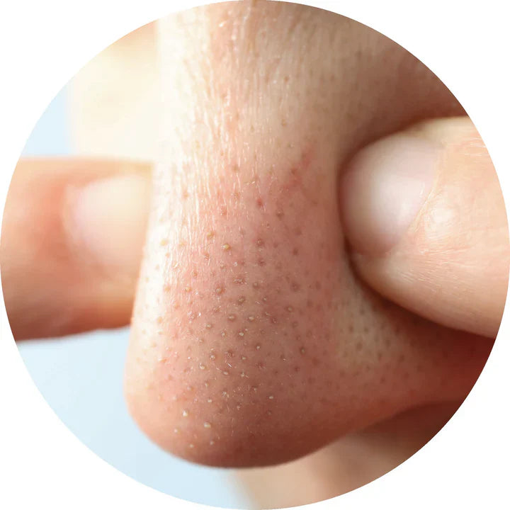 Blackheads