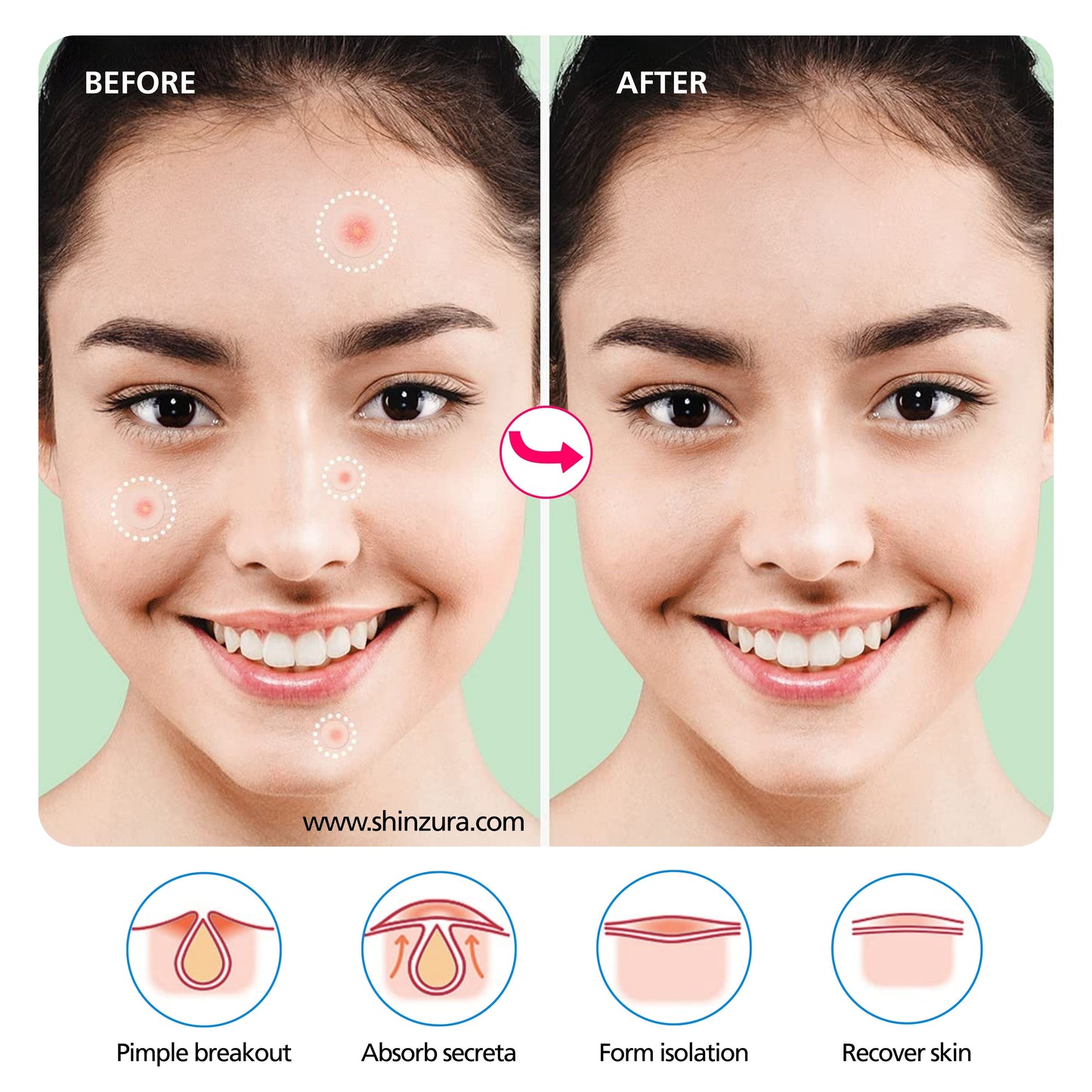 Shinzura Hydrocolloid Acne Patches with Salicylic Acid – 72 Dots