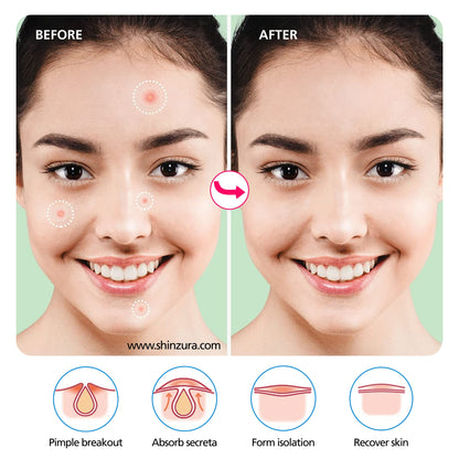 Shinzura Hydrocolloid Acne Patches with Salicylic Acid – 72 Dots